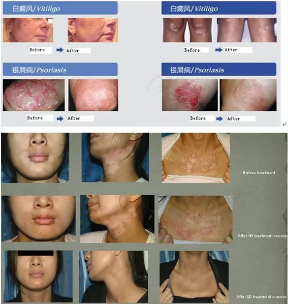 311nm narrowband uvb lampg